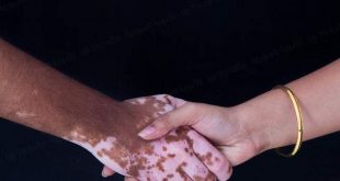 صحة - البهاق مرض غير معدي