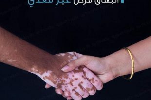 صحة - البهاق مرض غير معدي